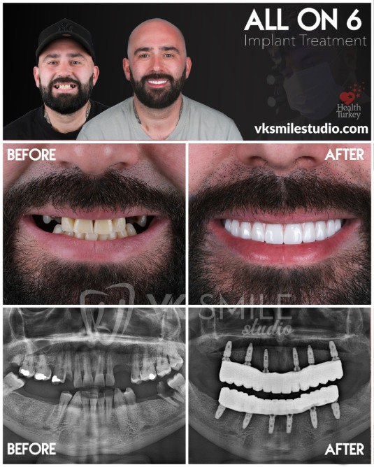 All-on-6 dental implants in Turkey