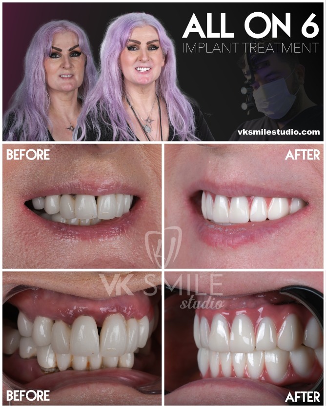 All-on-6 dental implants in Turkey