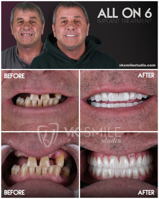 All-on-6 dental implants in Turkey
