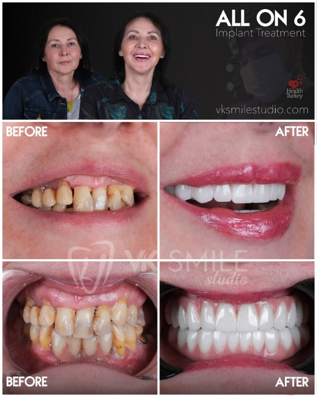 All-on-6 dental implants in Turkey