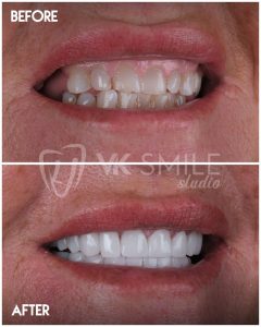 VK Smile Studio before after