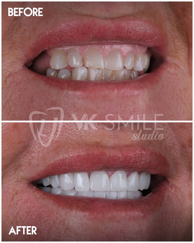 VK Smile Studio before after
