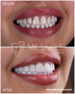 VK Smile Studio before after