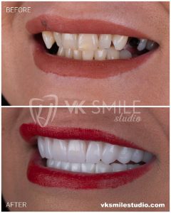 VK Smile Studio before after
