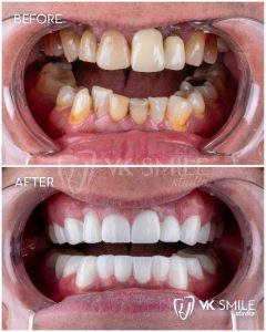 VK Smile Studio before after
