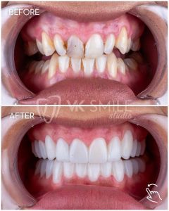 VK Smile Studio before after