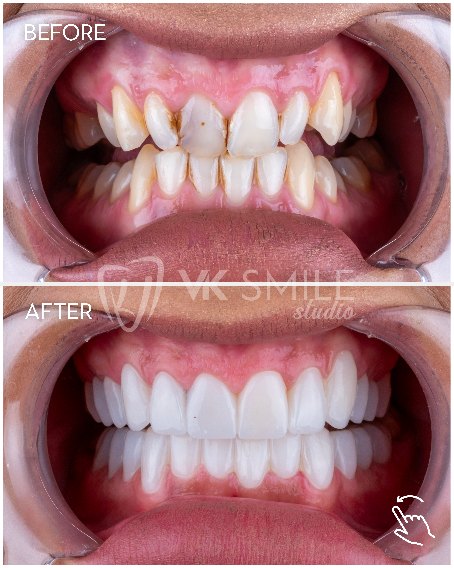 VK Smile Studio before after