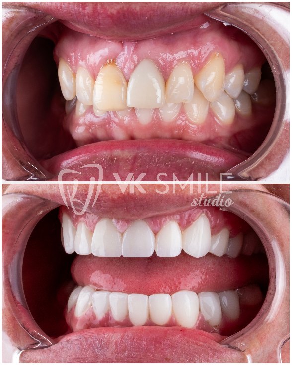 VK Smile Studio before after