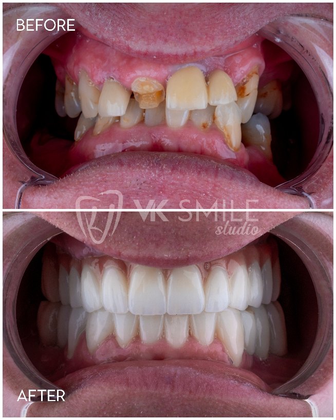 VK Smile Studio before after