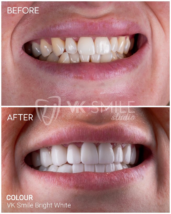 VK Smile Studio before after