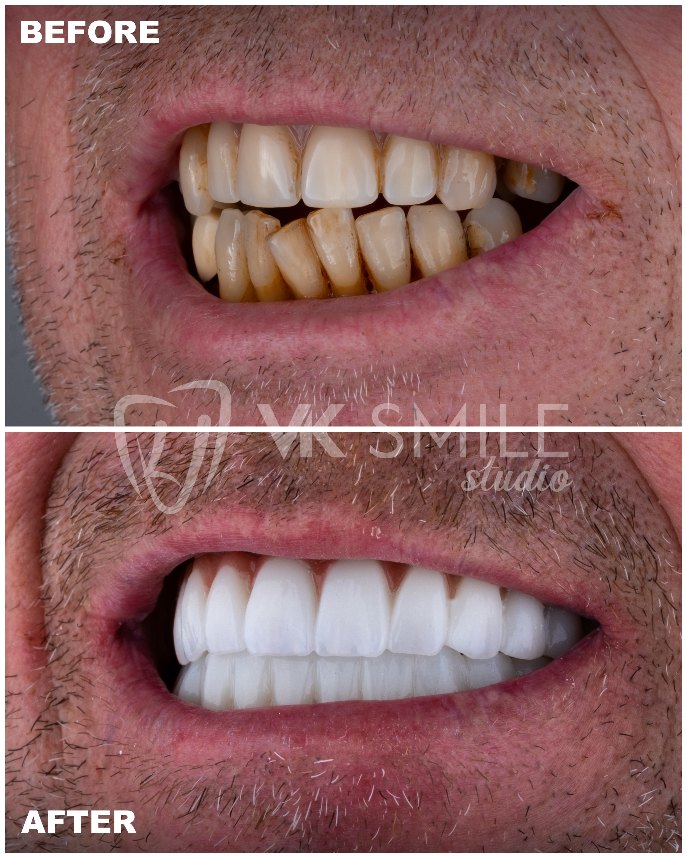 VK Smile Studio before after