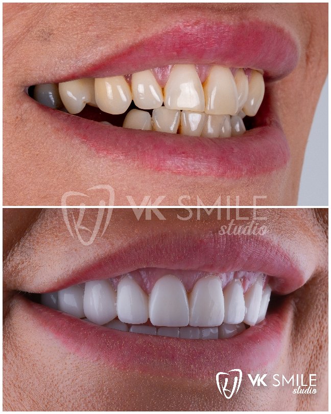 VK Smile Studio before after