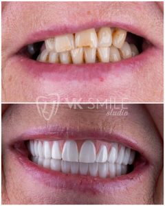 VK Smile Studio before after
