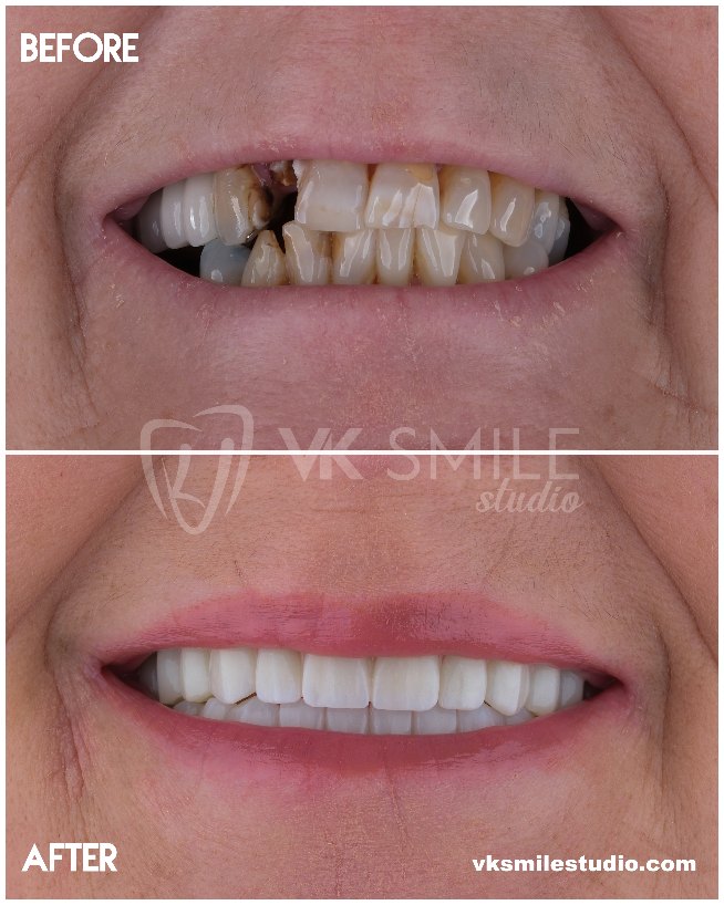 VK Smile Studio before after