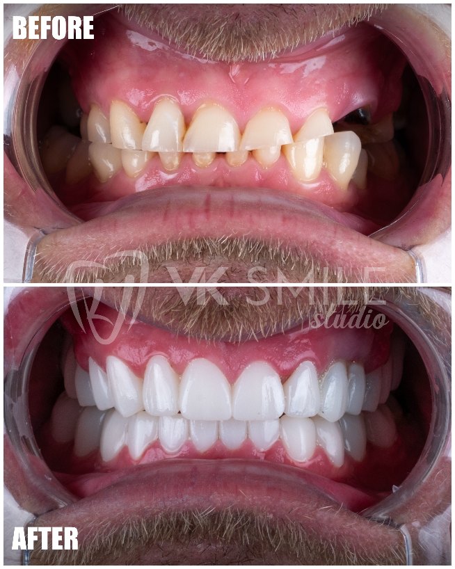 VK Smile Studio before after