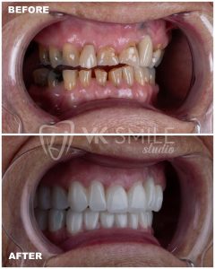 VK Smile Studio before after