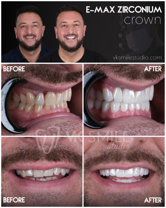 Dental crowns Turkey before after