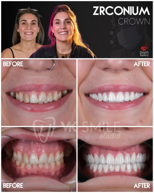 Dental crowns Turkey before after