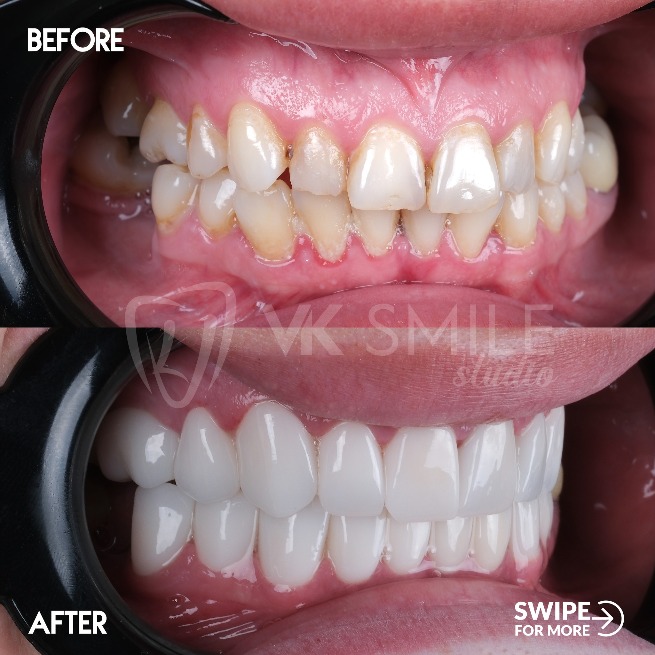 before after veneers vk smile