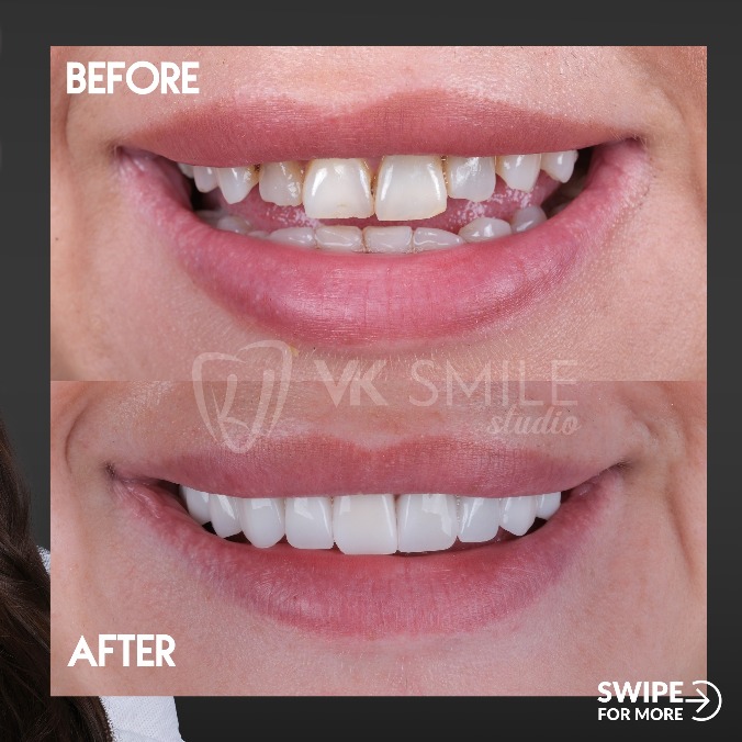 before after veneers