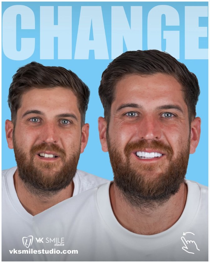 Dental veneers before&after