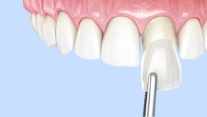 What is the best age to get veneers?