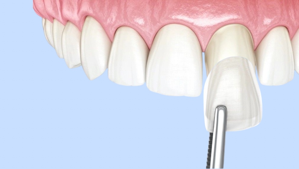 What is the best age to get veneers?