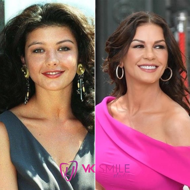 Catherine Zeta-Jones teeth