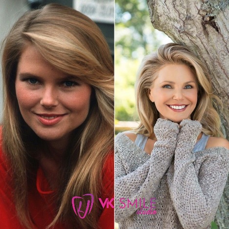 Christie Brinkley teeth