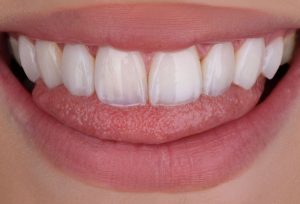 Composite bonding in Turkey