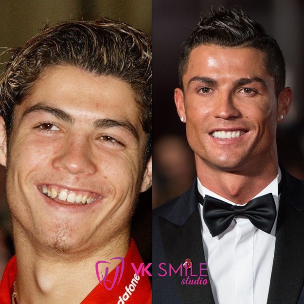 Cristiano Ronaldo teeth before after