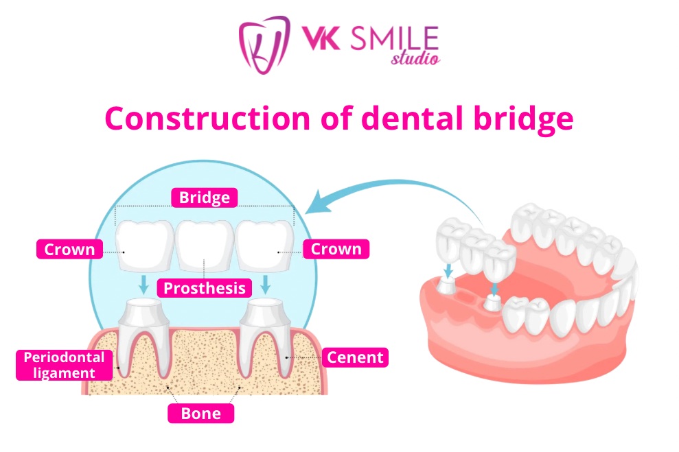 dental bridge structure