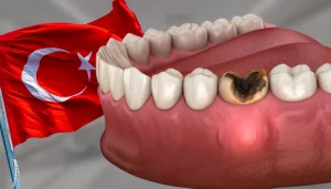 Understanding dental cysts: Treatment options and costs in Turkey
