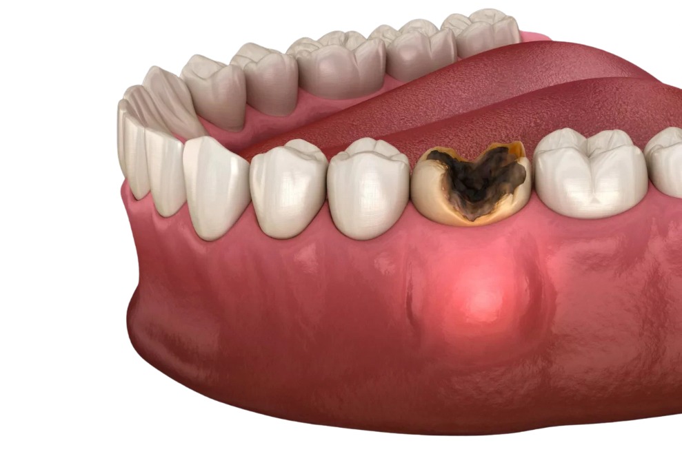 dental cysts