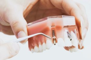 dental implants in Turkey