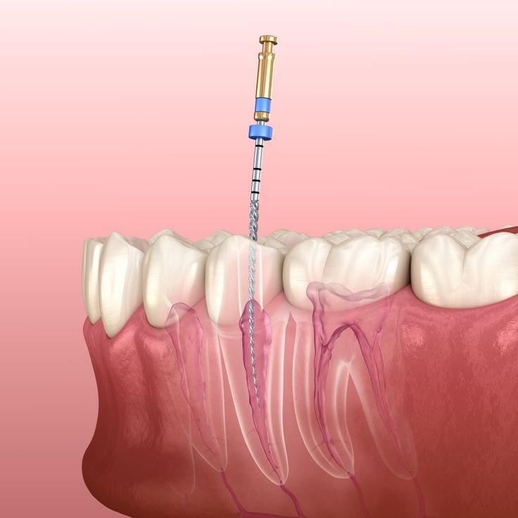 dental nerve removal at a dental centre in Turkey