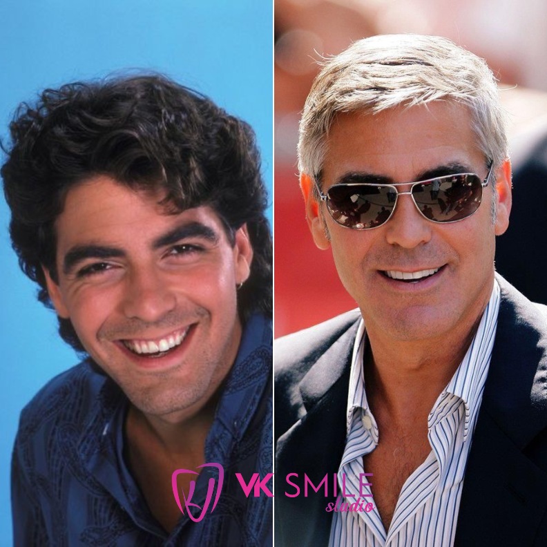 George Clooney teeth