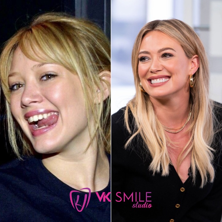 Hilary Duff teeth