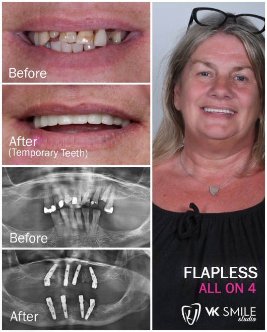 Same day dental implants in Turkey with immediate load fixed teeth restoration