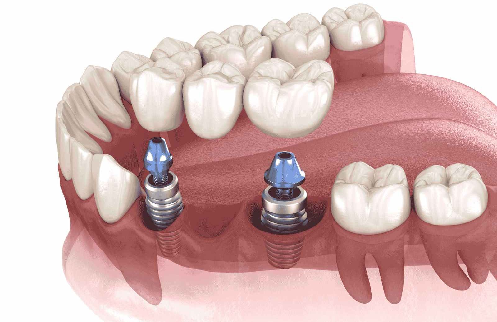 Implantatgestützte Brücke