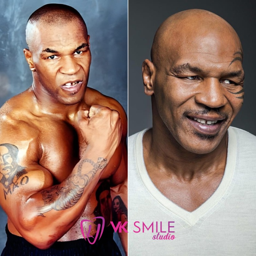 Mike Tyson teeth