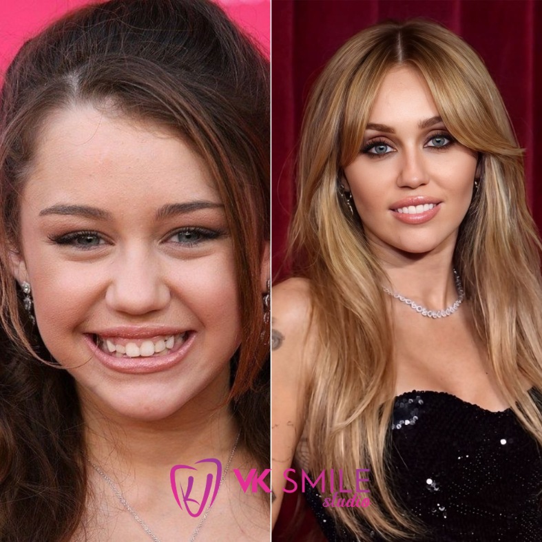 Miley Cyrus teeth