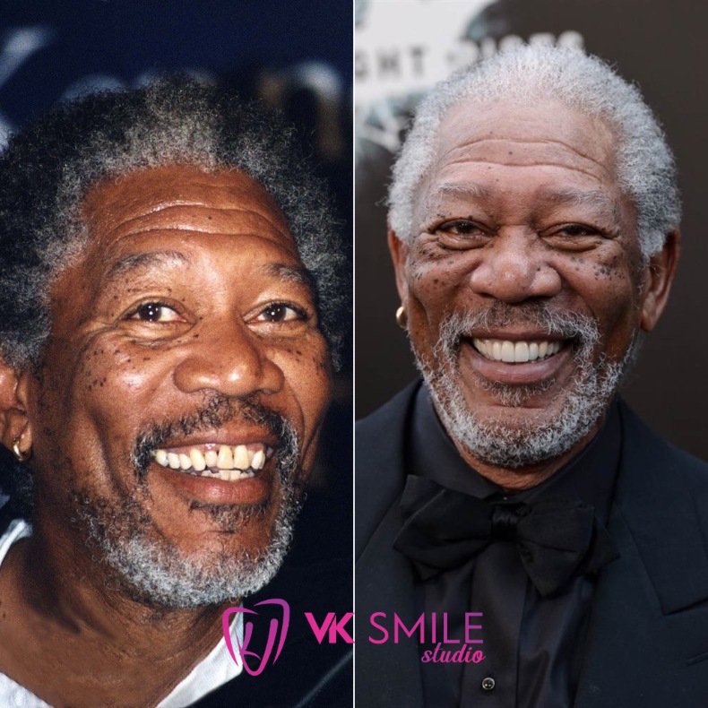 Morgan Freeman teeth