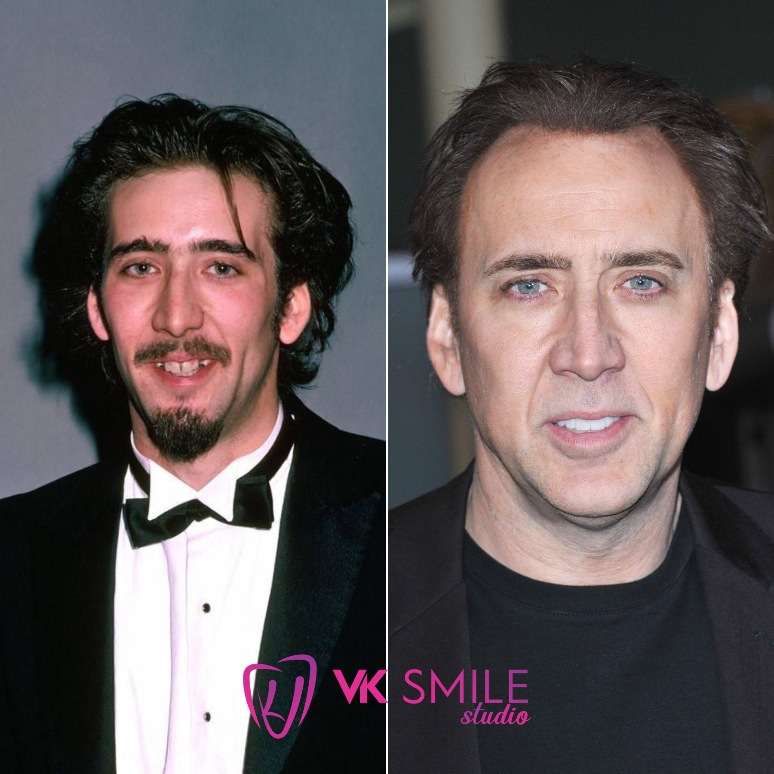 Nicholas Cage teeth