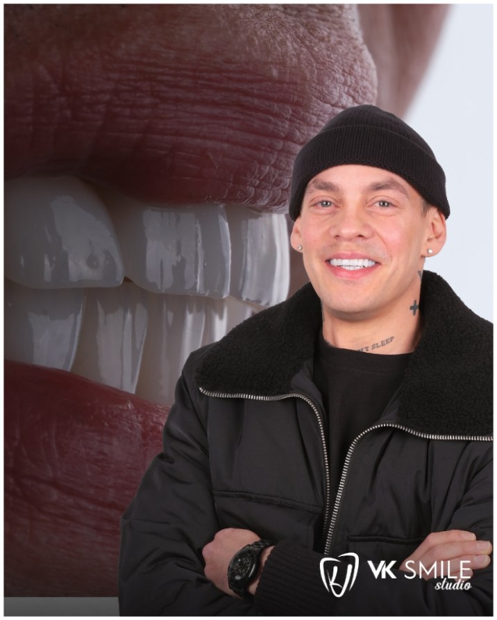 No-prep veneers in Turkey