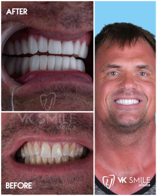 Veneers without shaving teeth before and after photos of minor chips and discolouration case.