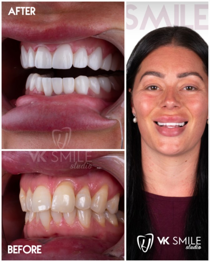 No-prep veneers before/after