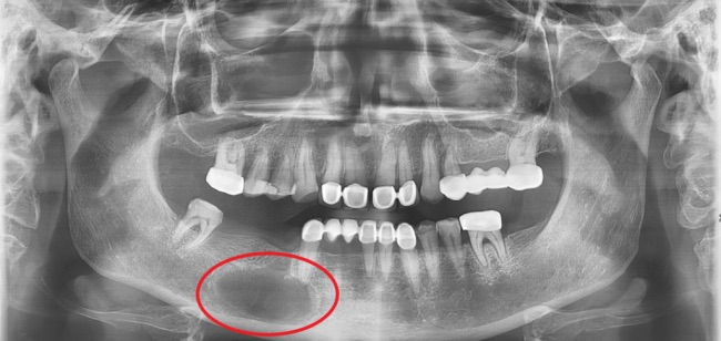3D pictures of dental cysts