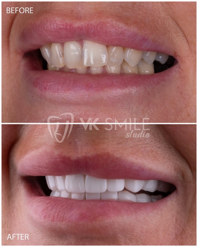 Before and after Hollywood smile design with porcelain veneers at VK Smile Studio