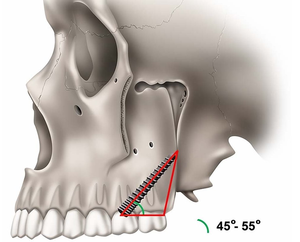pterygoid-dental-implants